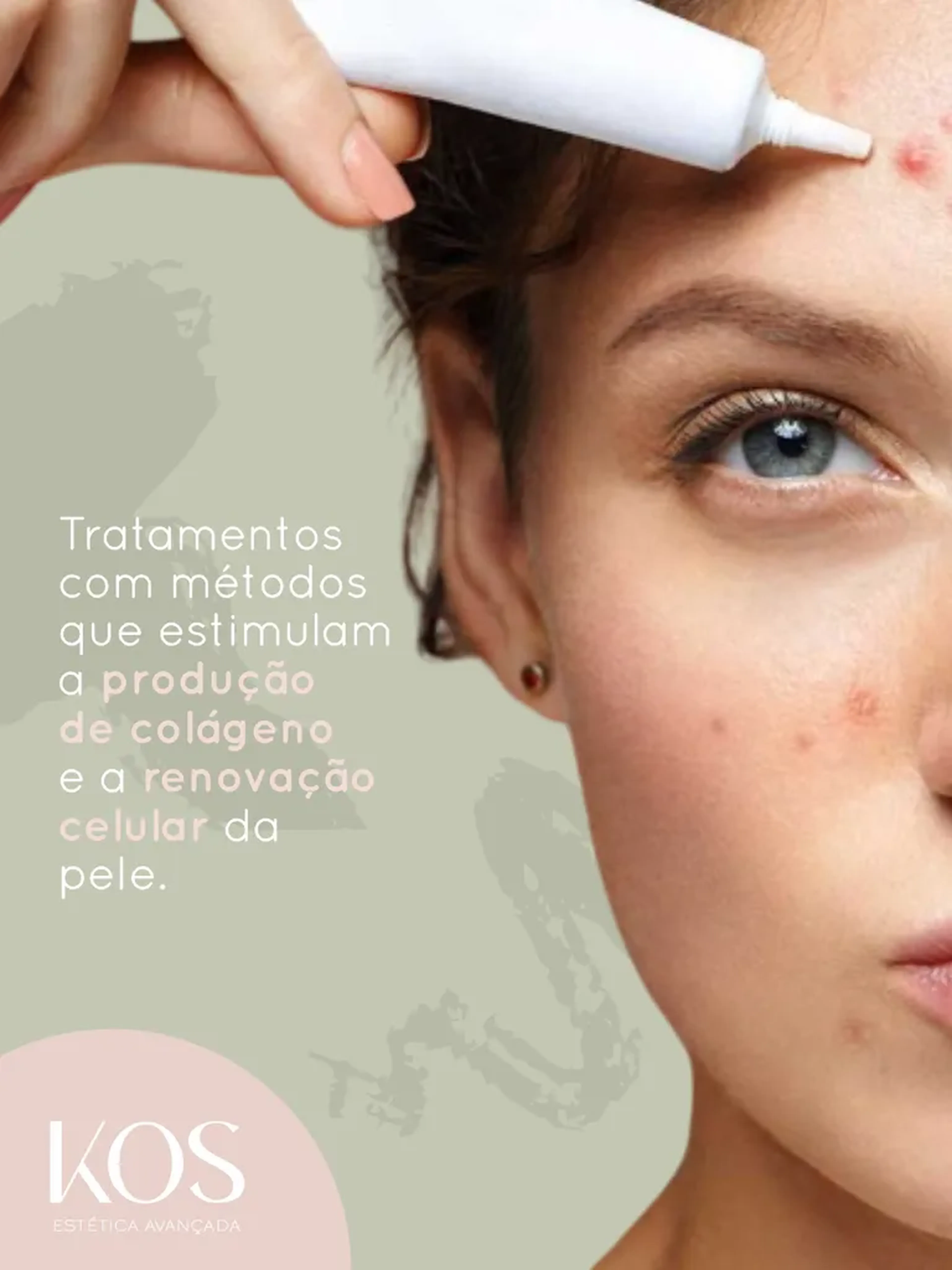 Acne - 5 sessões imagem