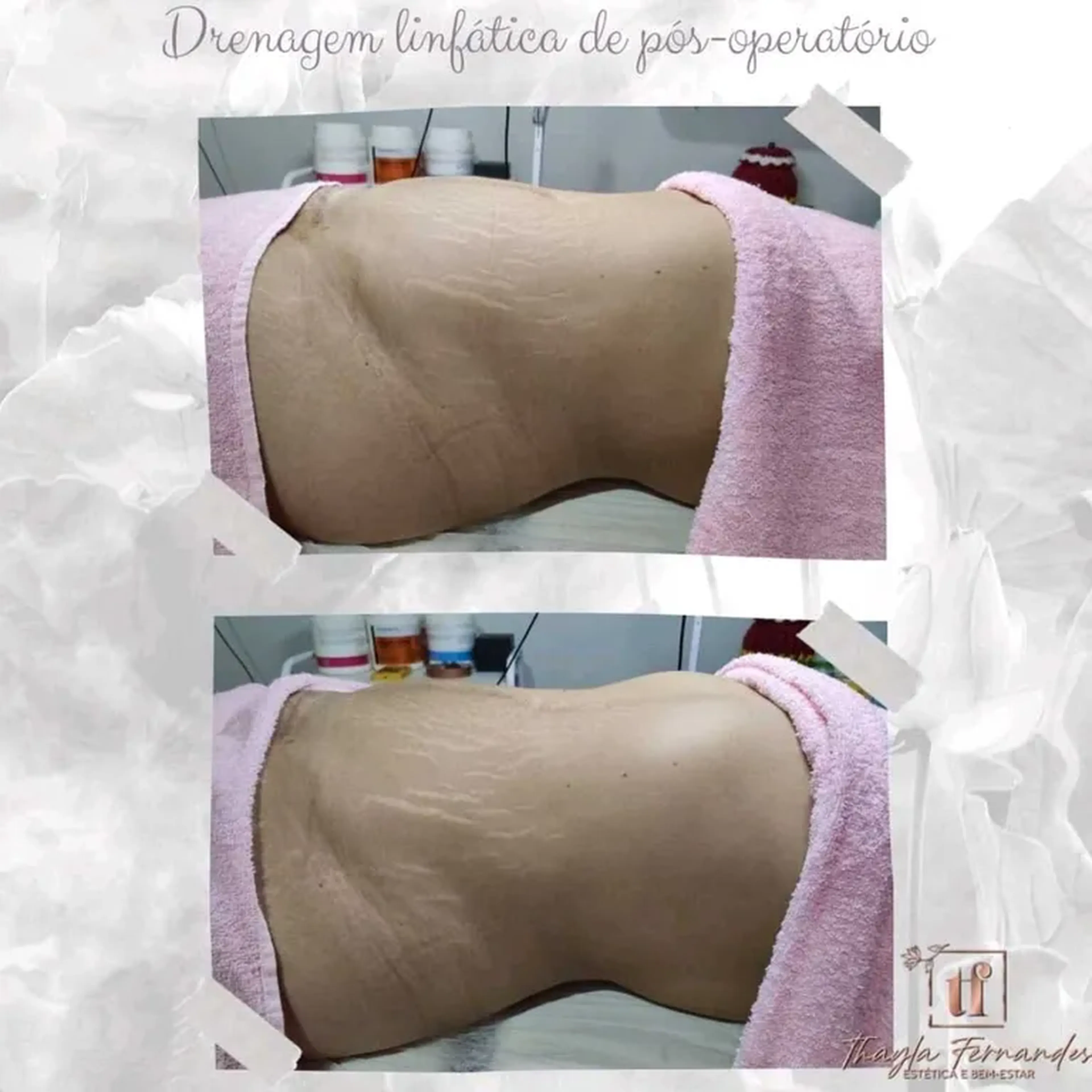 Drenagem Pós-Operatório imagem