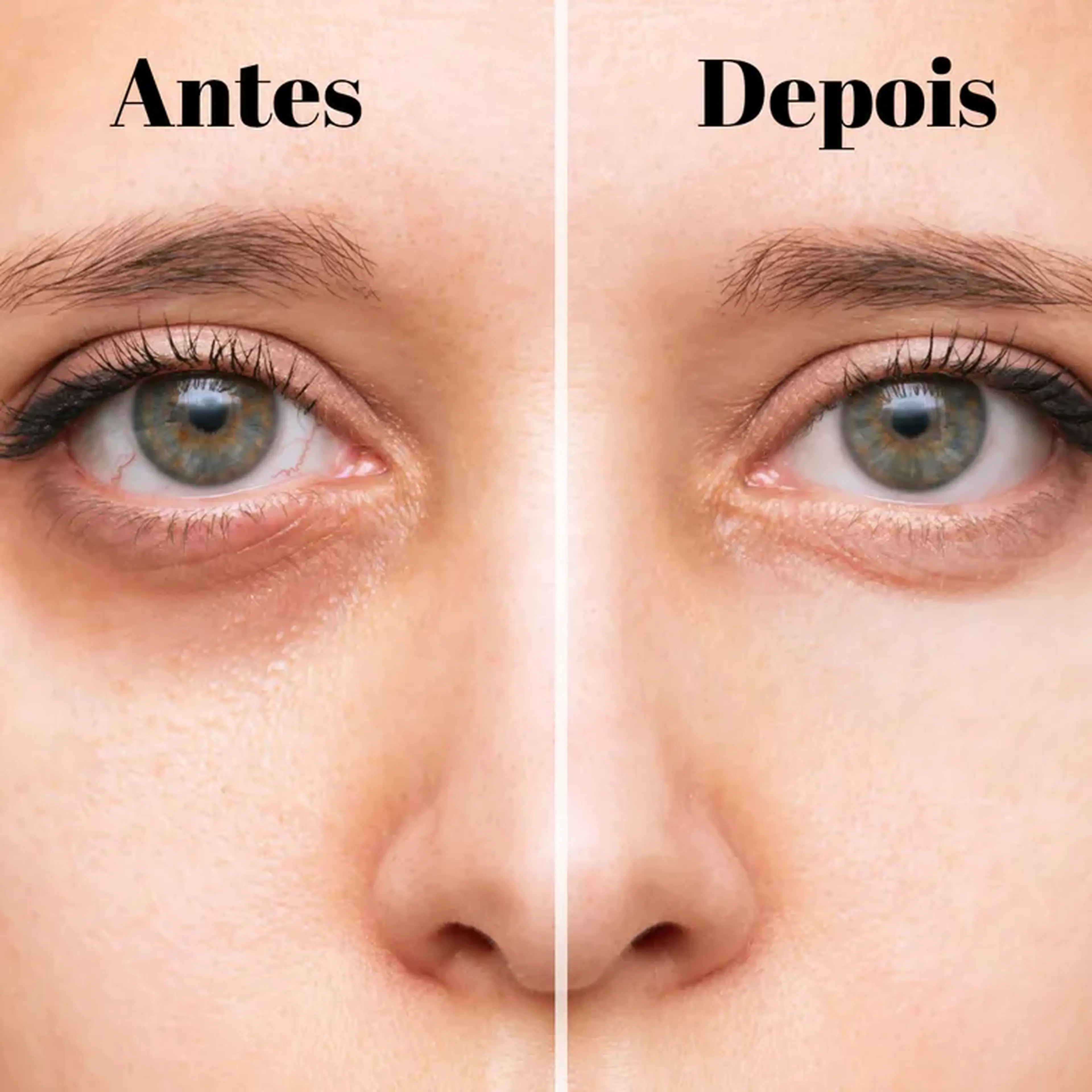 Olheiras Clareamento imagem