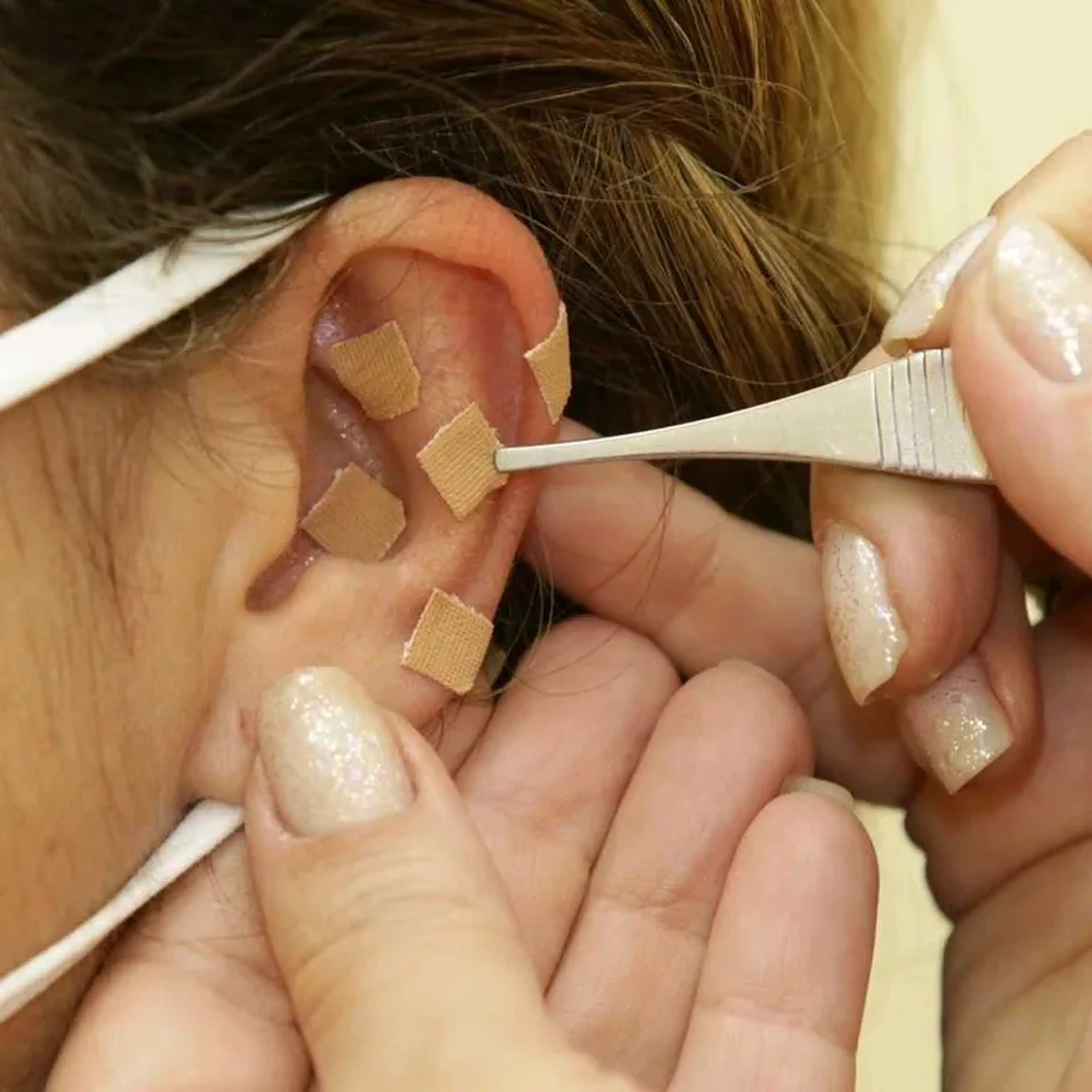 AURICULOTERAPIA imagem