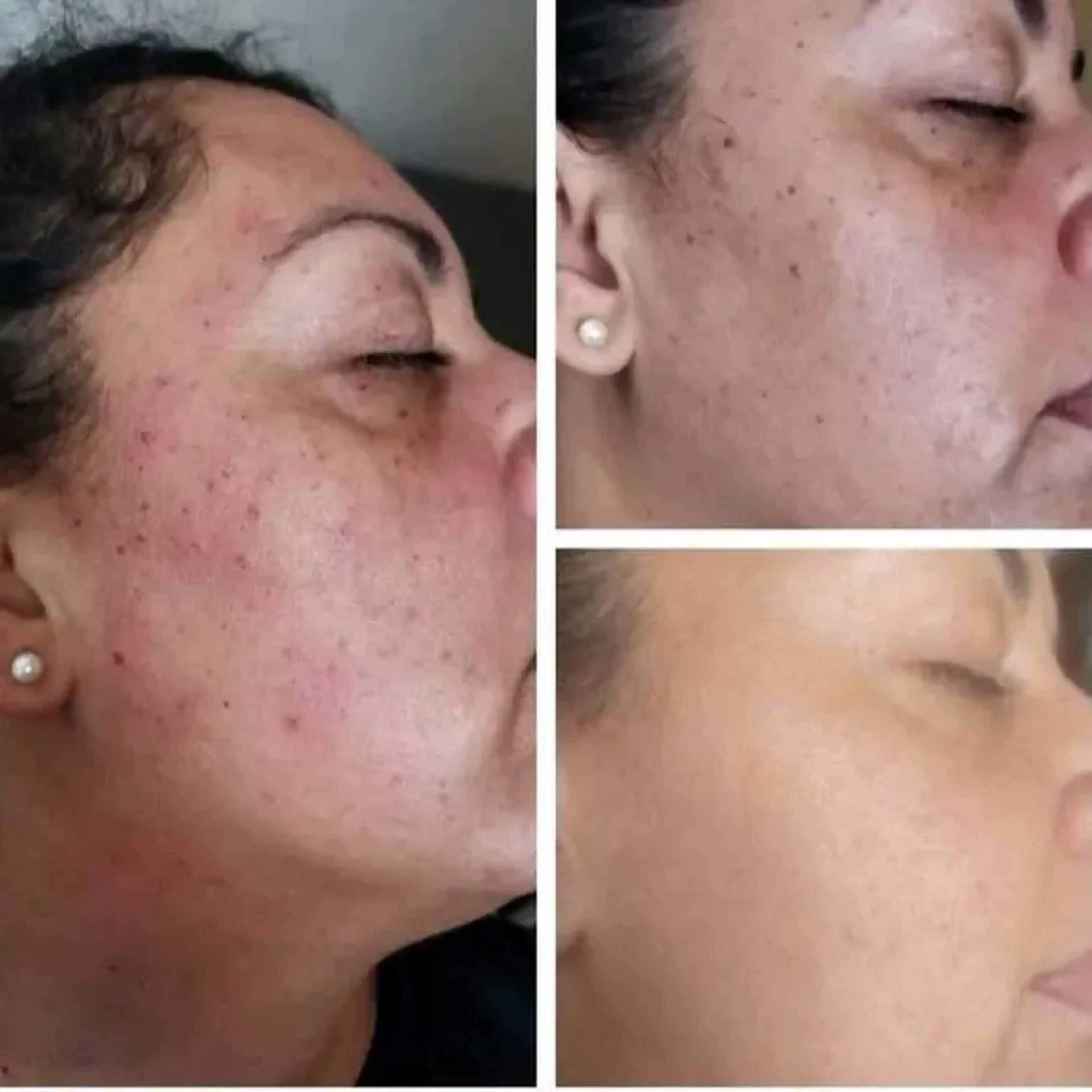 Jato de Plasma remoção verruguinhas imagem