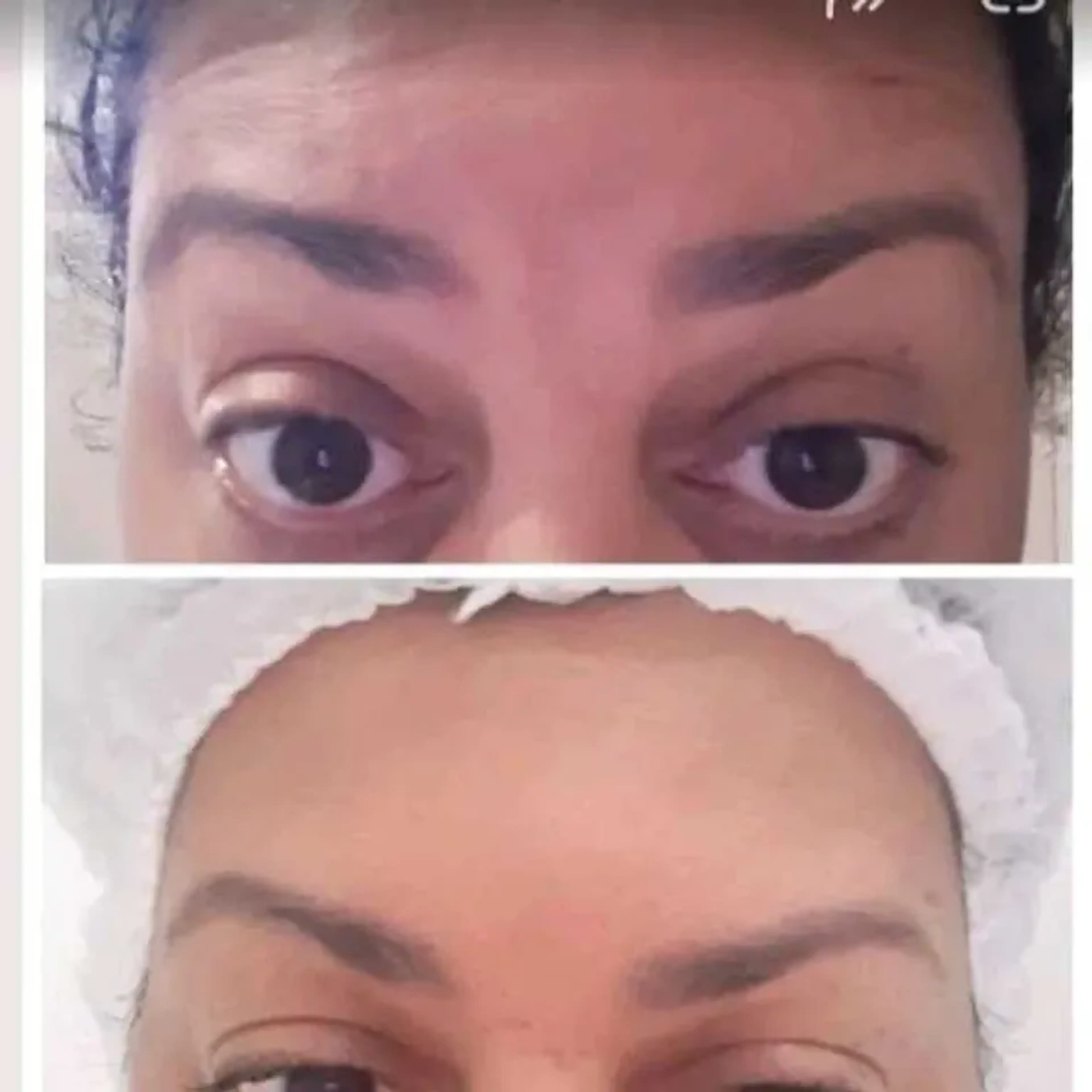 Botox 50 ui imagem
