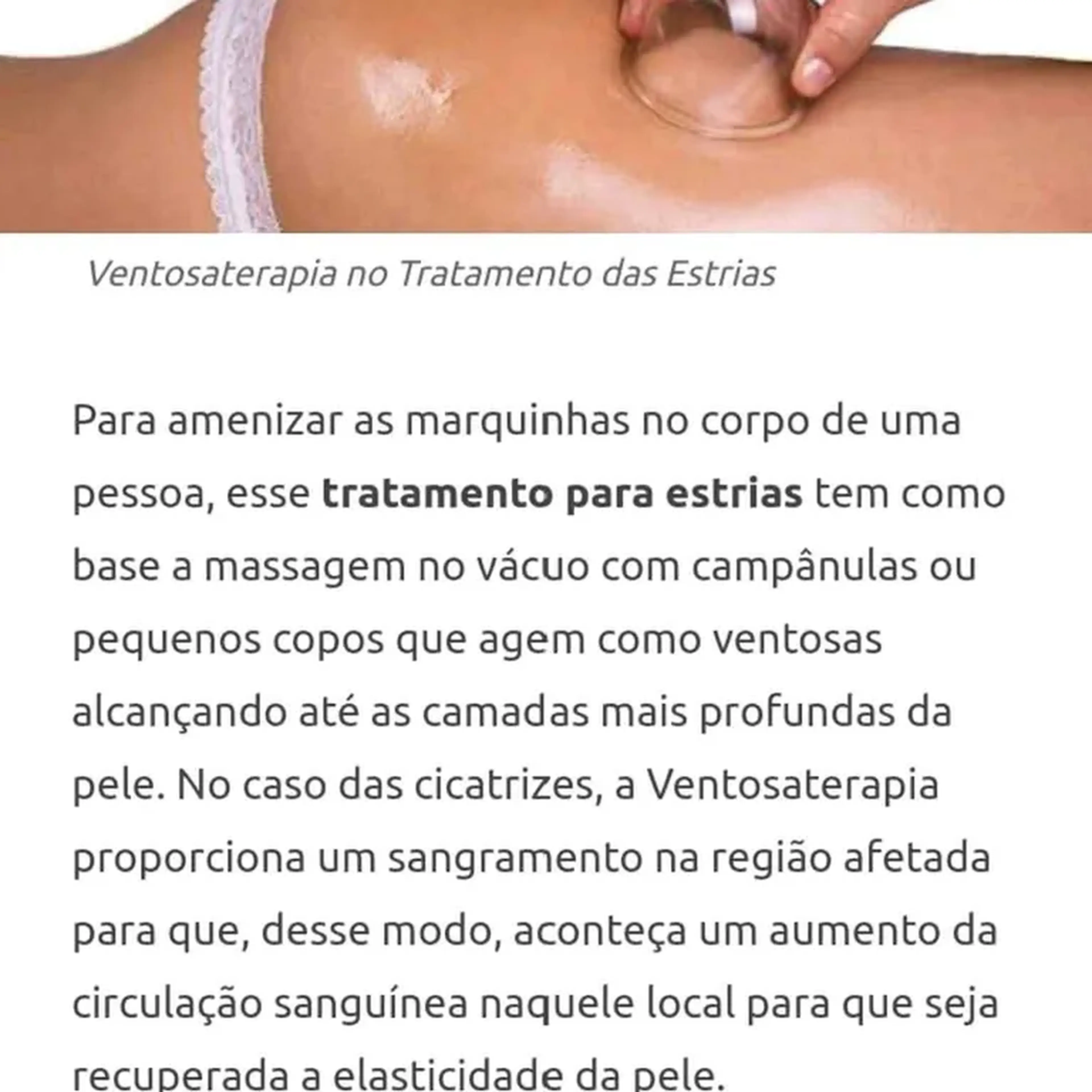 Ventosaterapia para estrias (Região) imagem