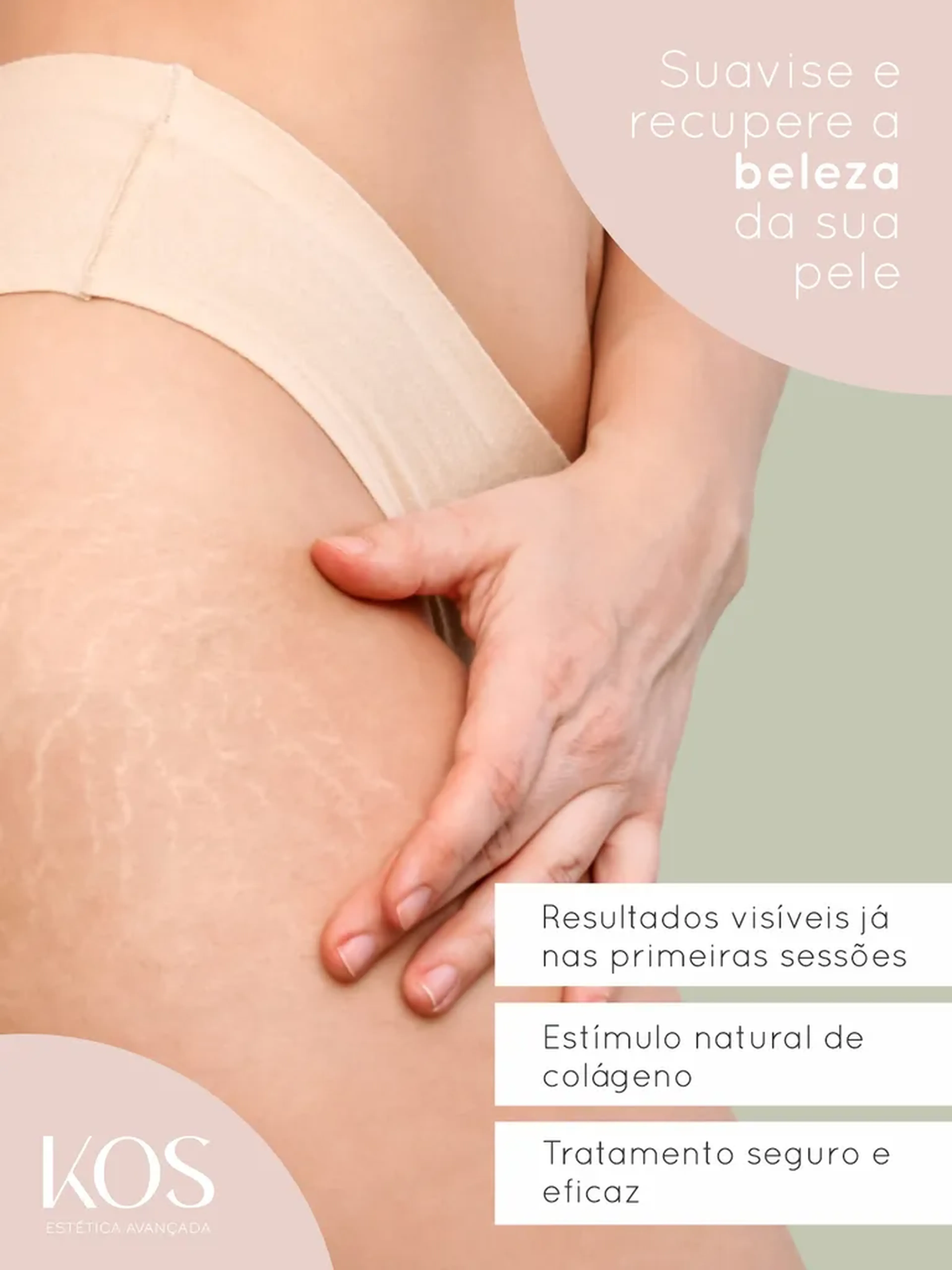 Estrias - 5 Sessões imagem