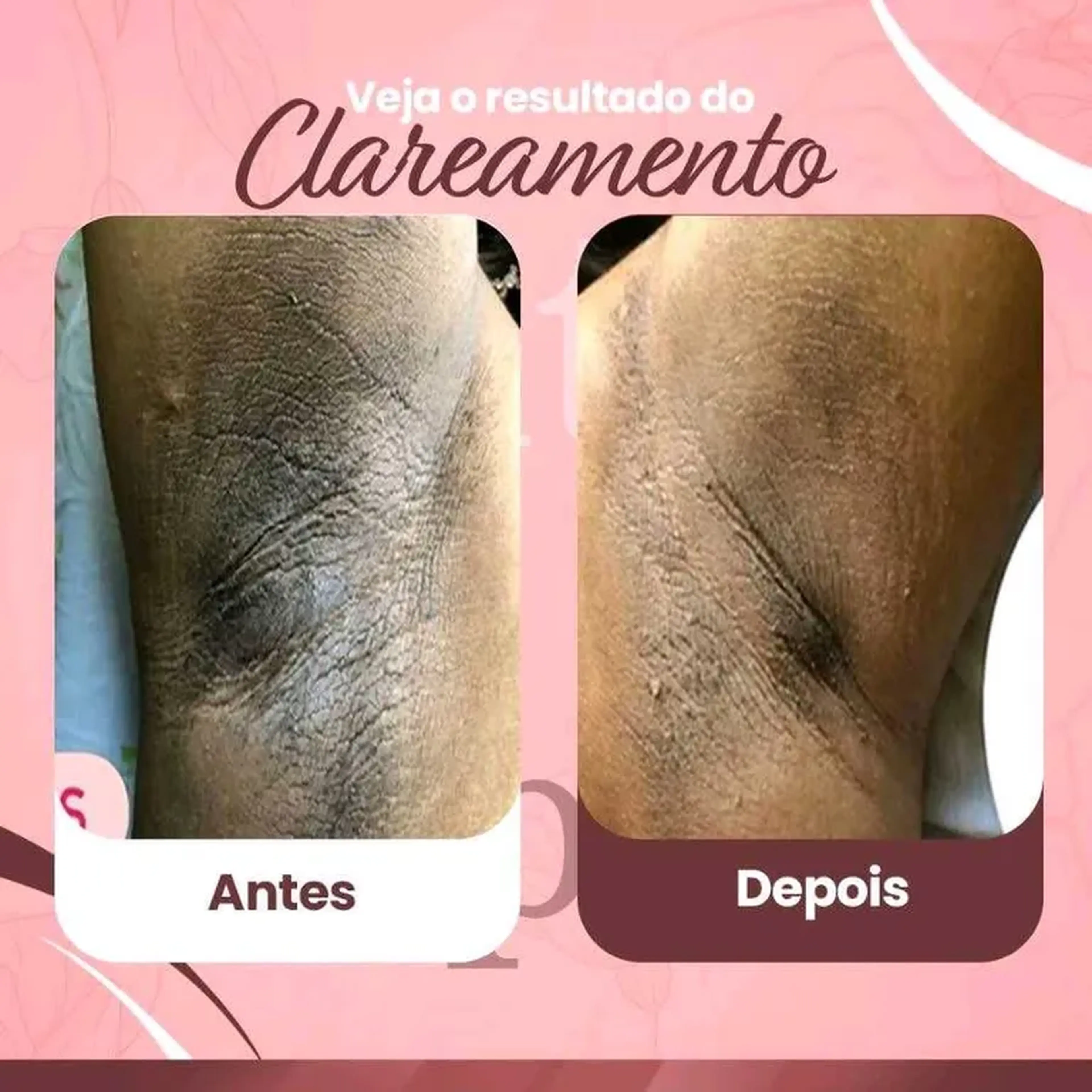 Clareamento de pele imagem