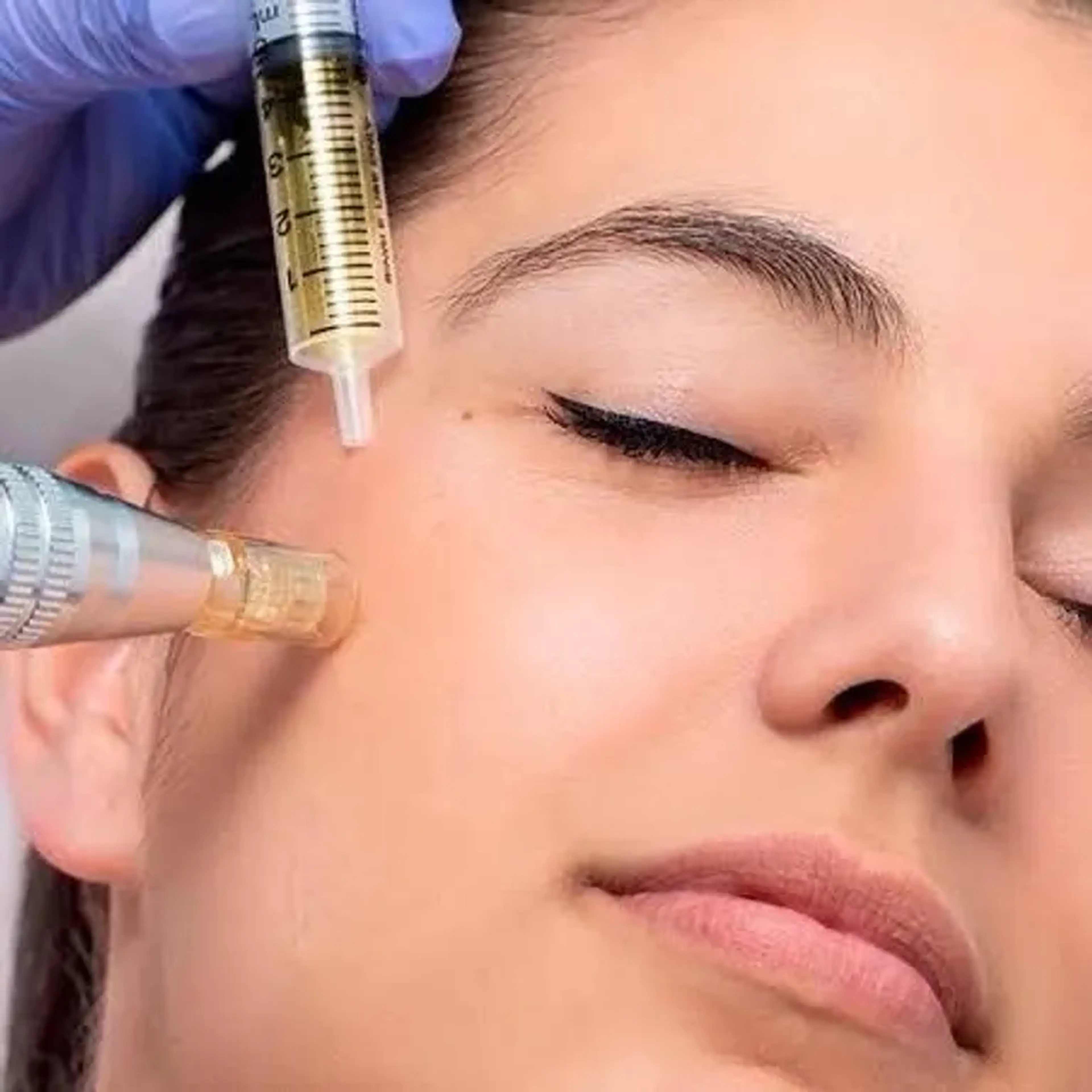 Microagulhamento com Vitamina C imagem