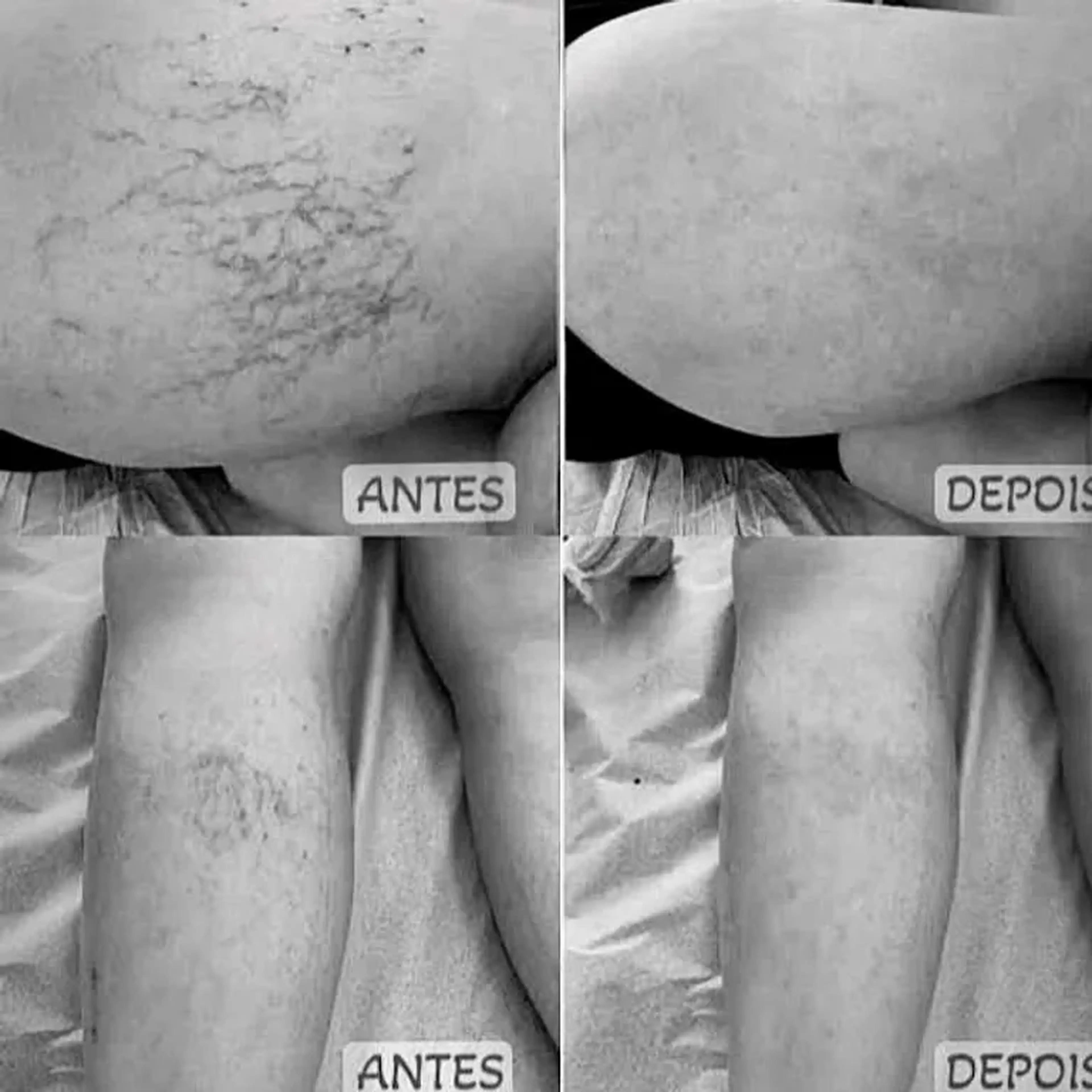 Tratamento de Escleroterapia ( secagem de Vasinhos) PEIM imagem