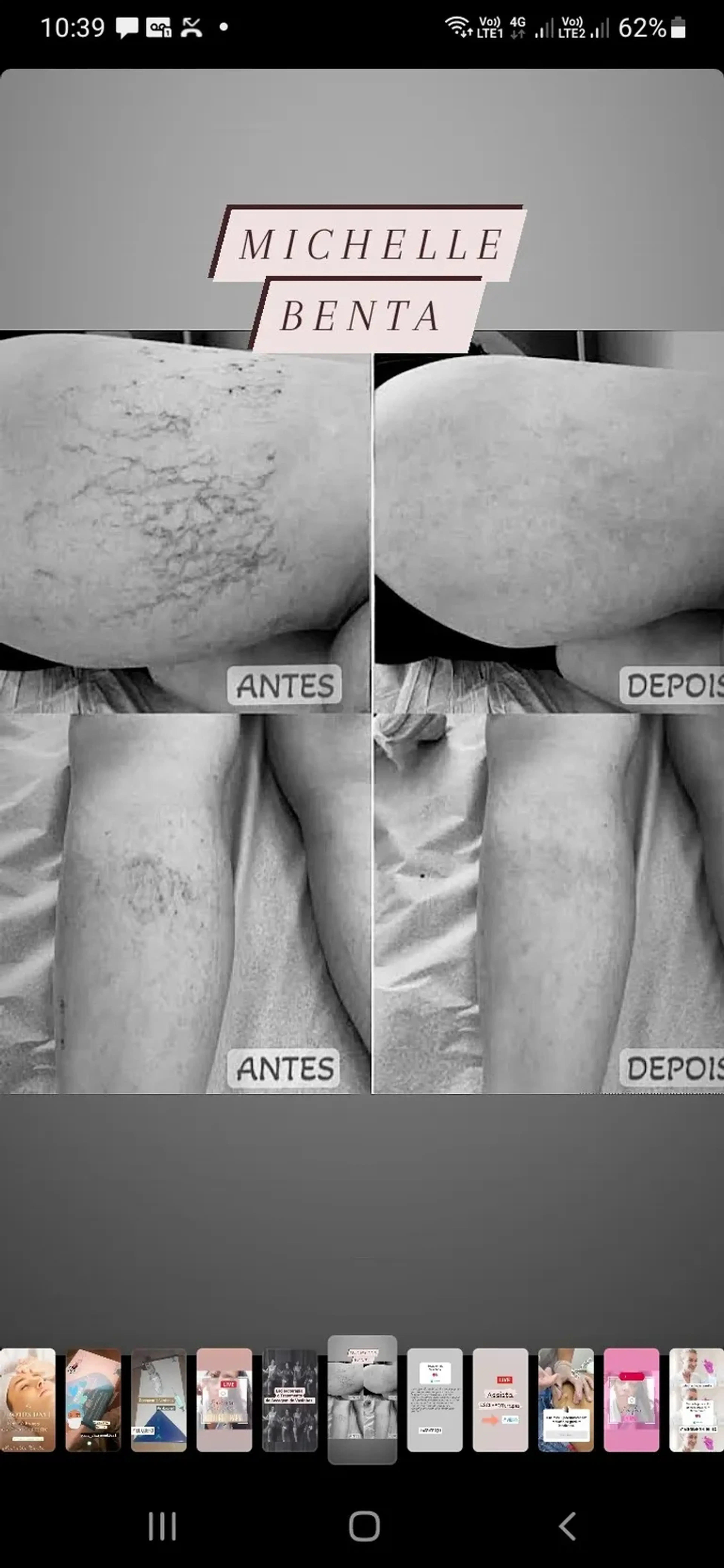Escleroterapia ( secagem de vasinhos) imagem