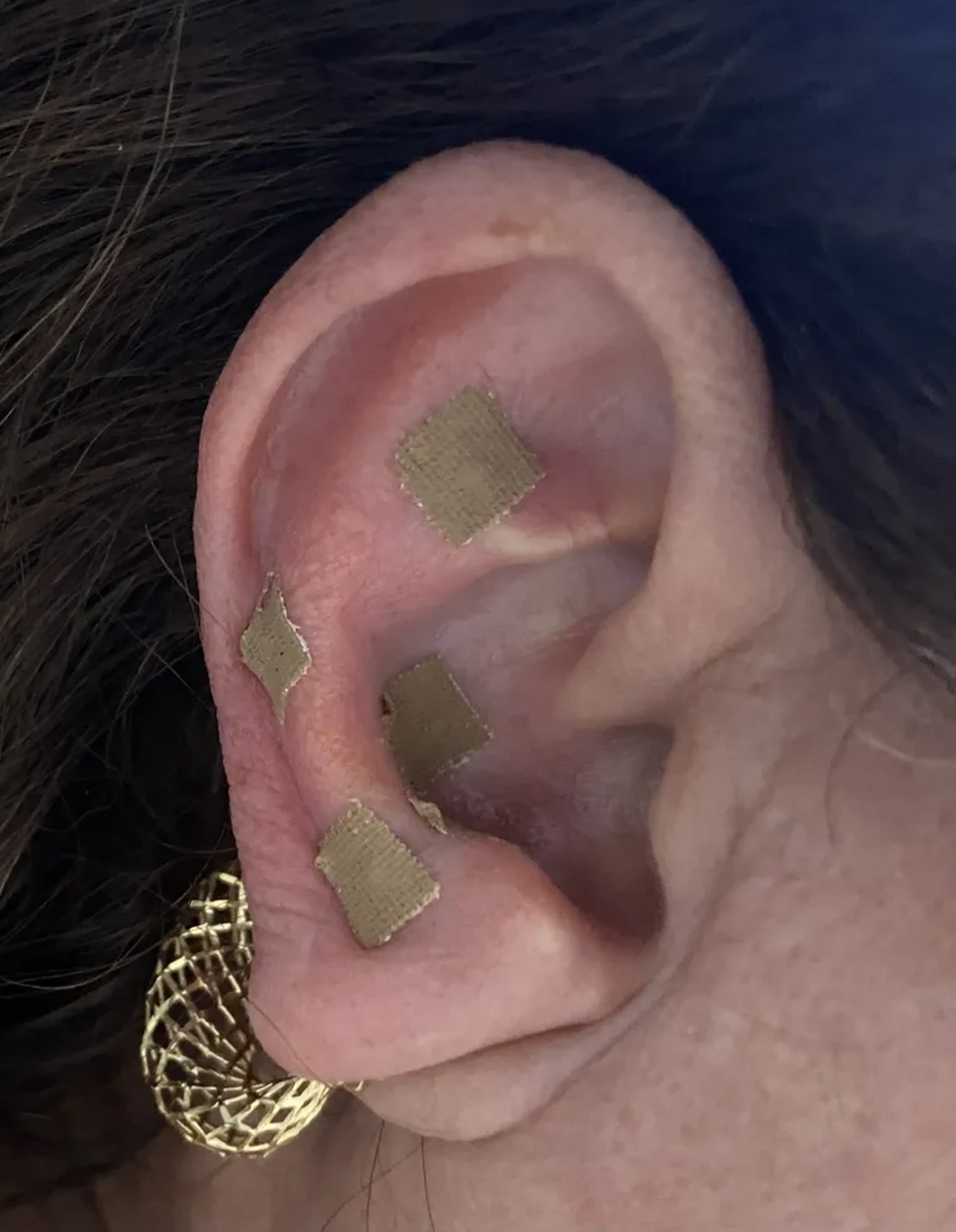 Auriculoterapia imagem