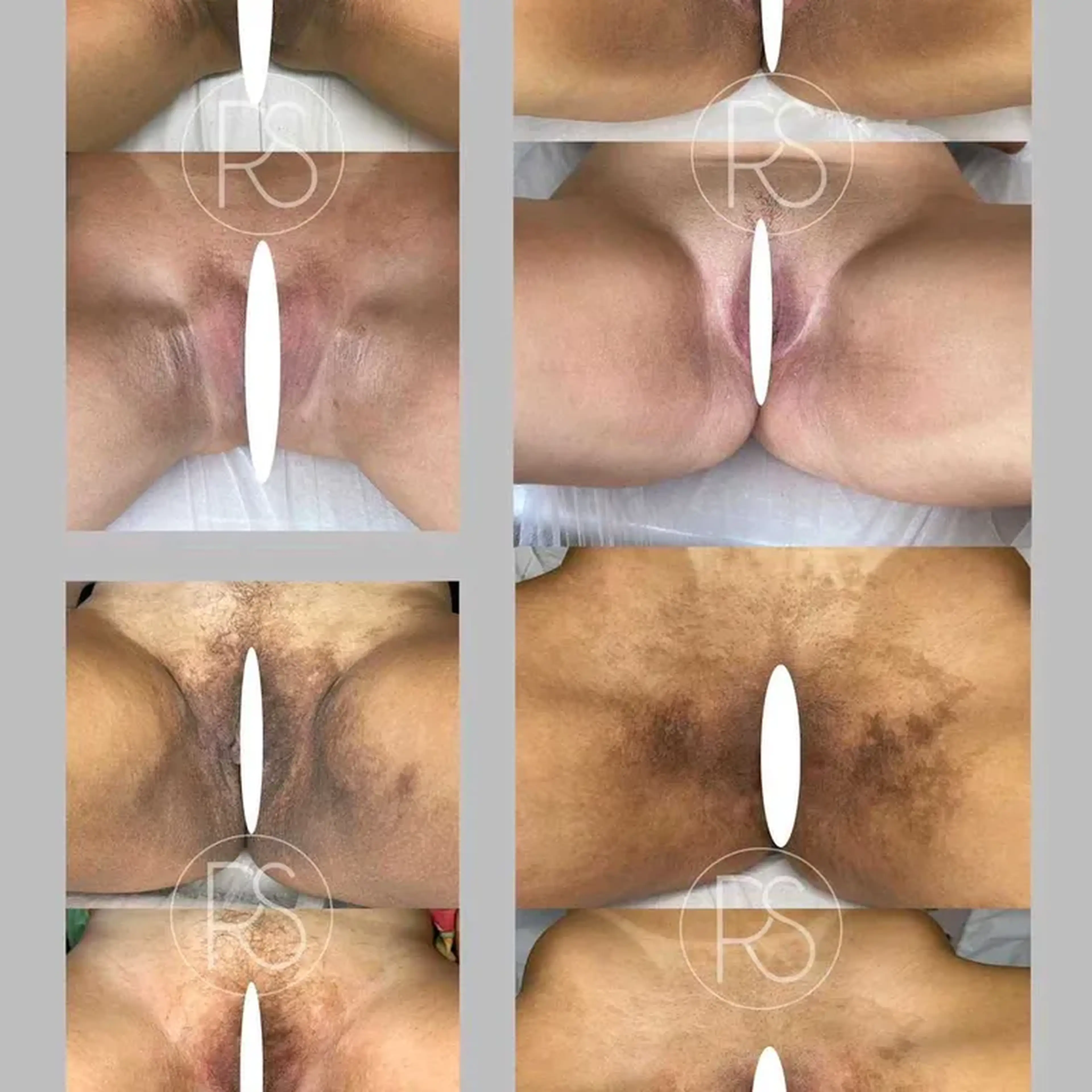 clareamento axila, virilha, coxa cotovelo imagem