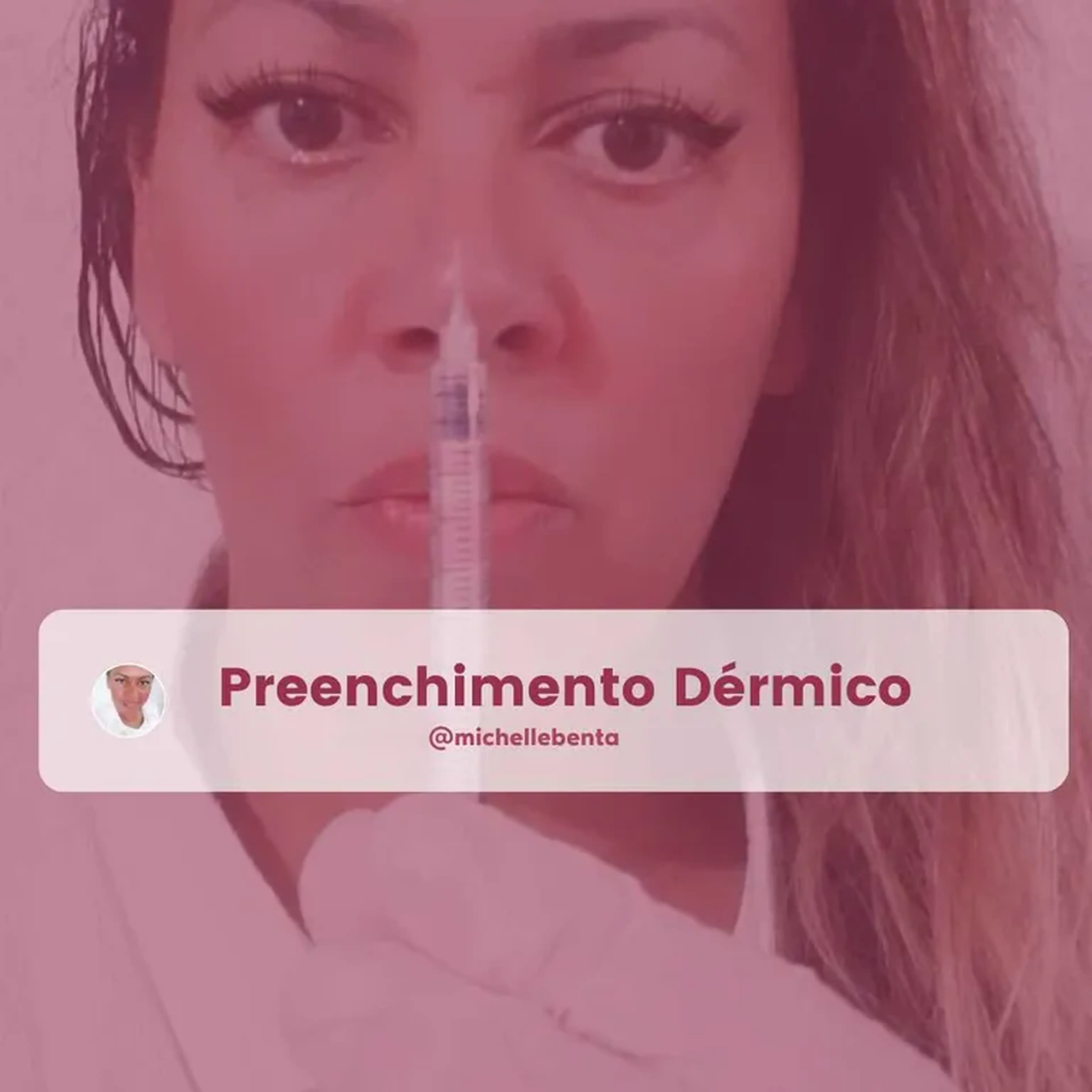 Preenchimento Labial imagem