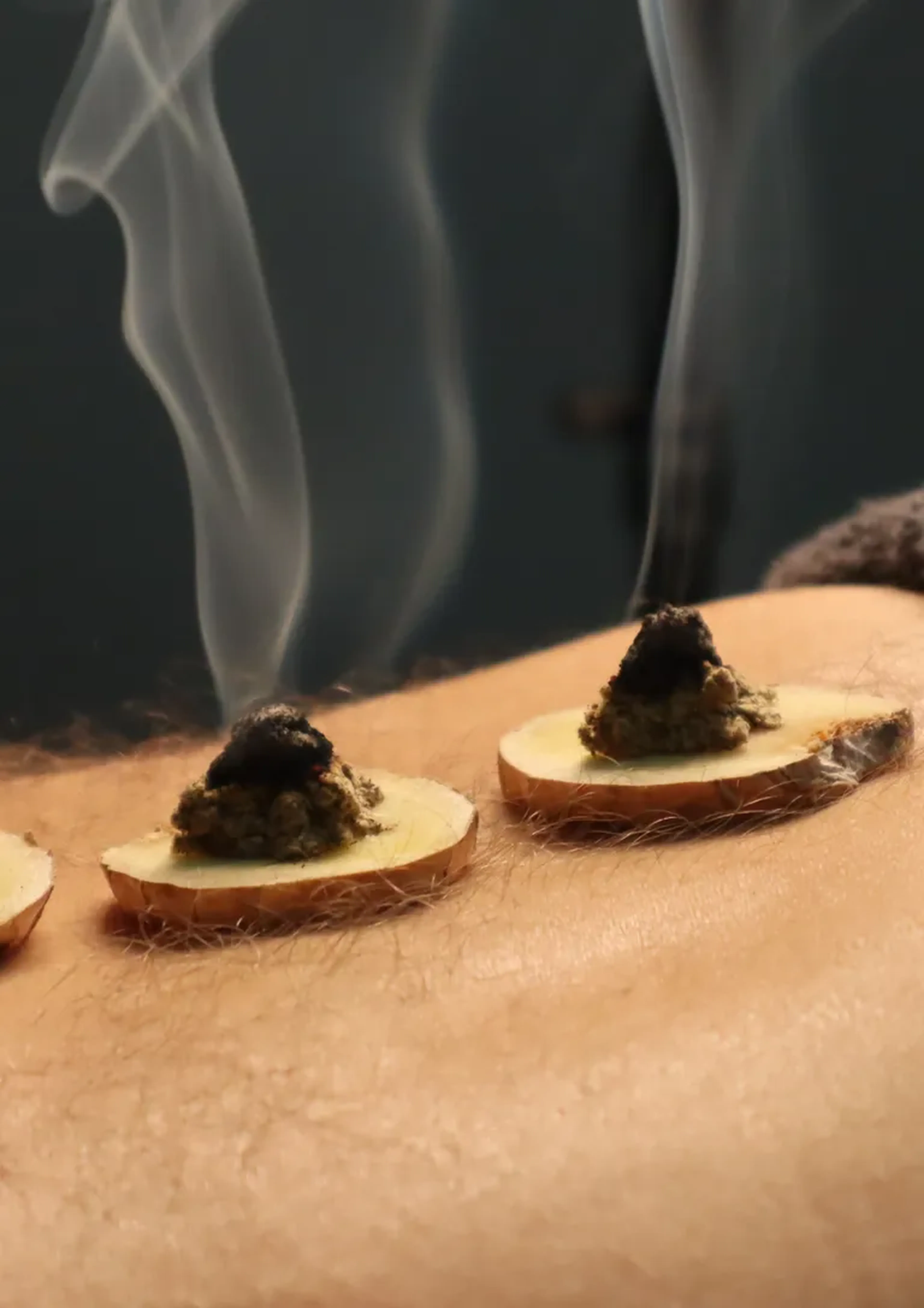 MOXABUSTÃO E VENTOSATERAPIA imagem