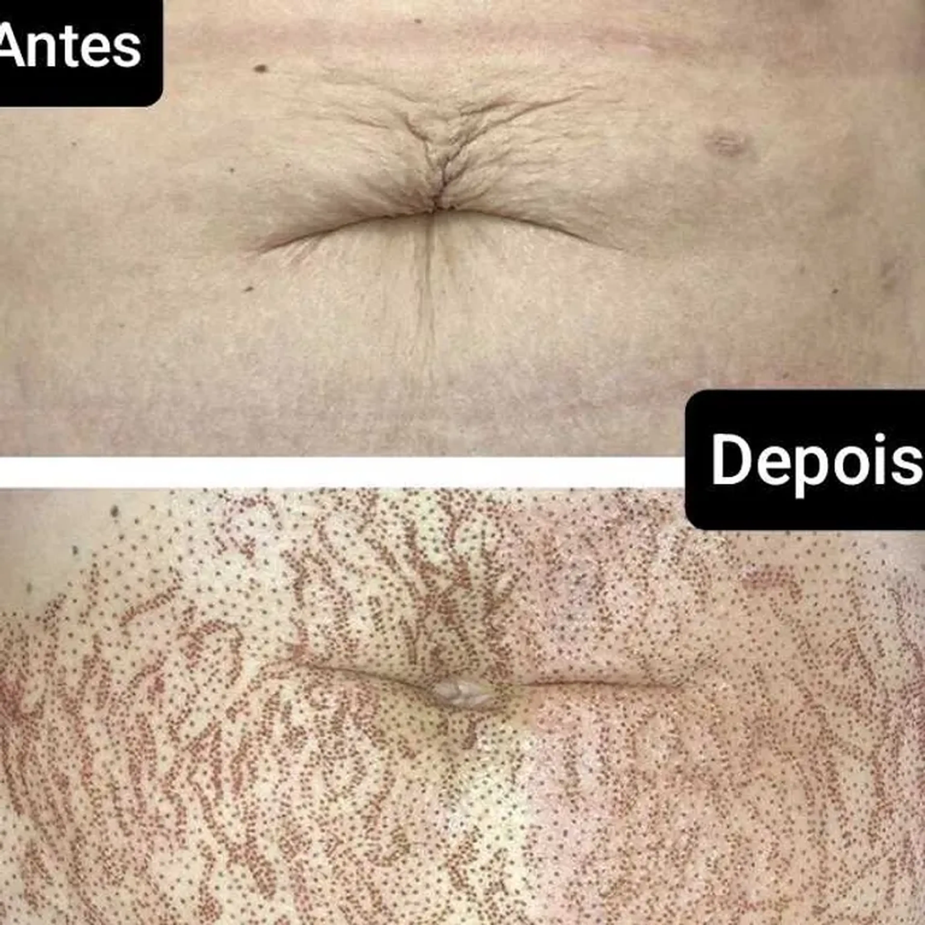 Jato de Plasma trate estrias imagem