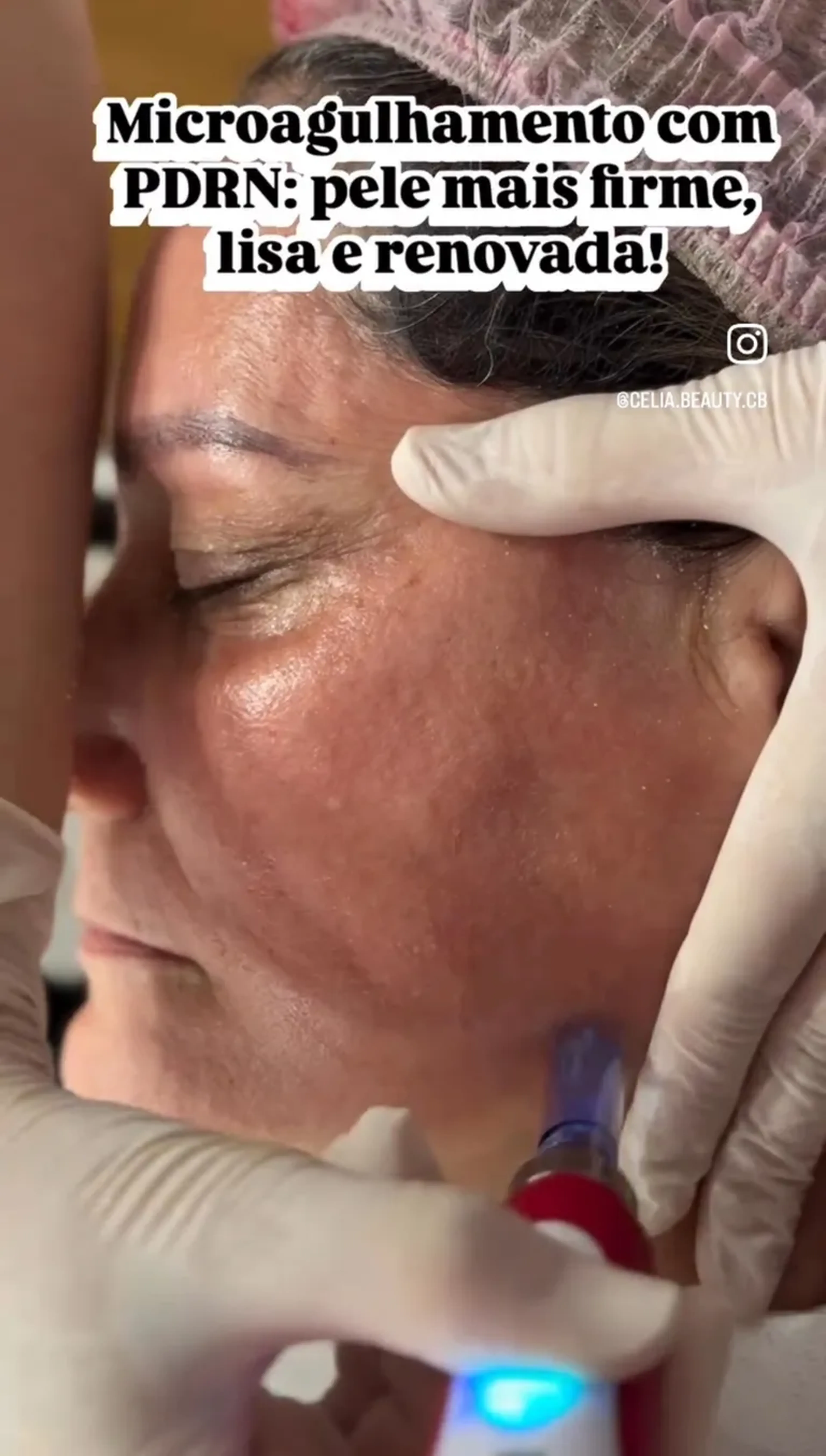 Rejuvenescedor microagulhamento mais PDRN imagem
