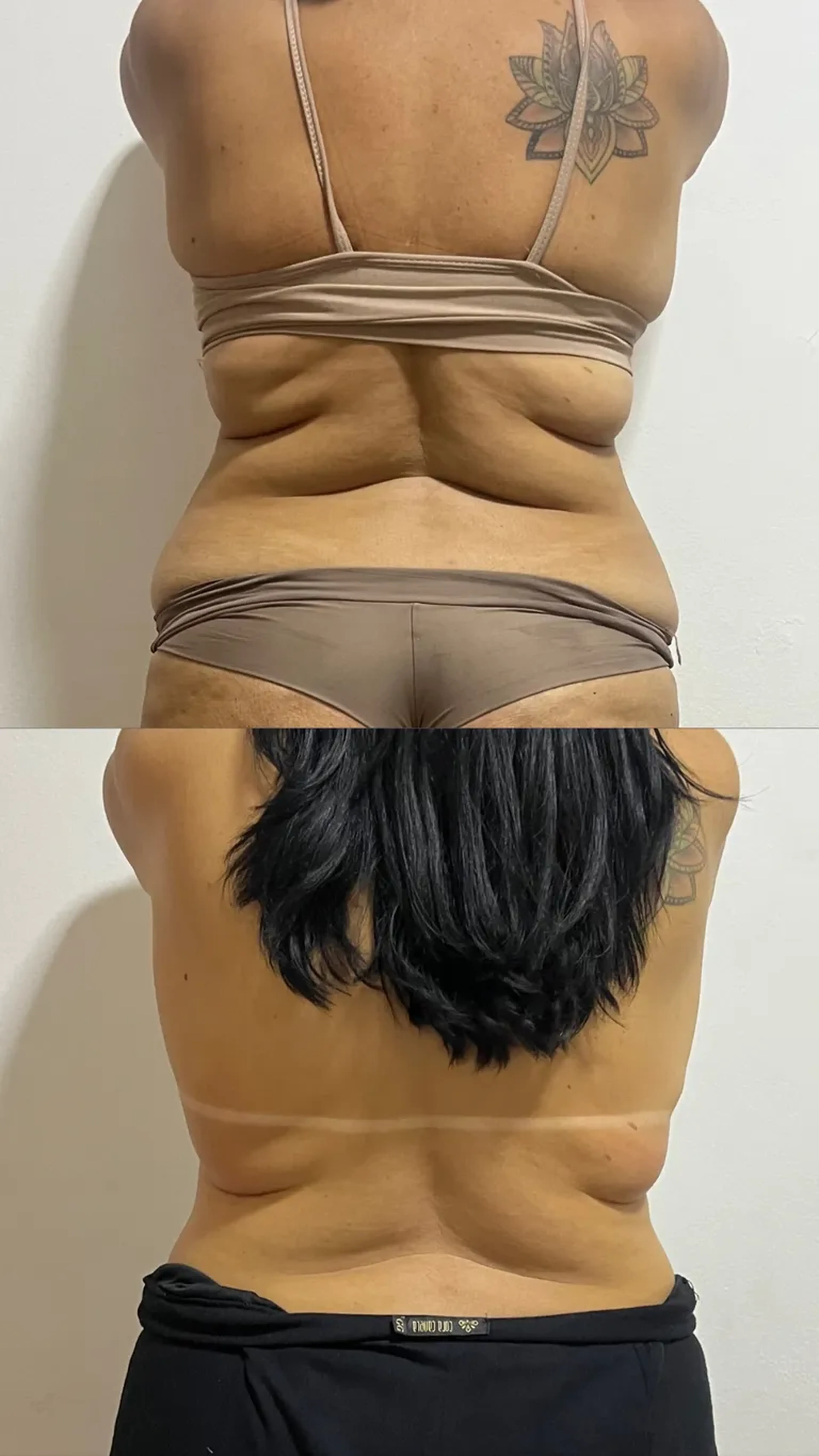 Sessão Enzimas Lipoturbinada imagem