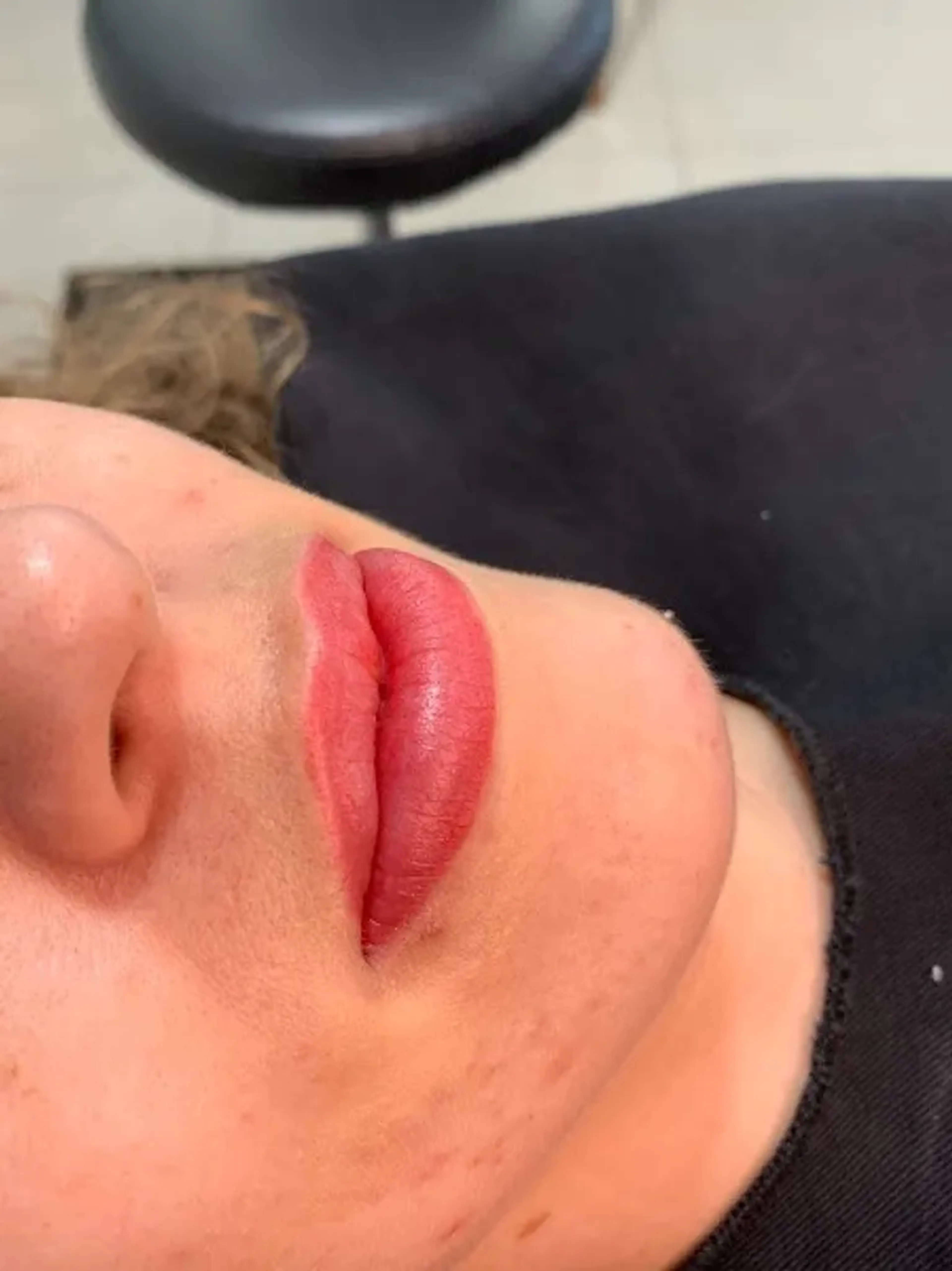 Revitalização Labial (1ª sessão) imagem