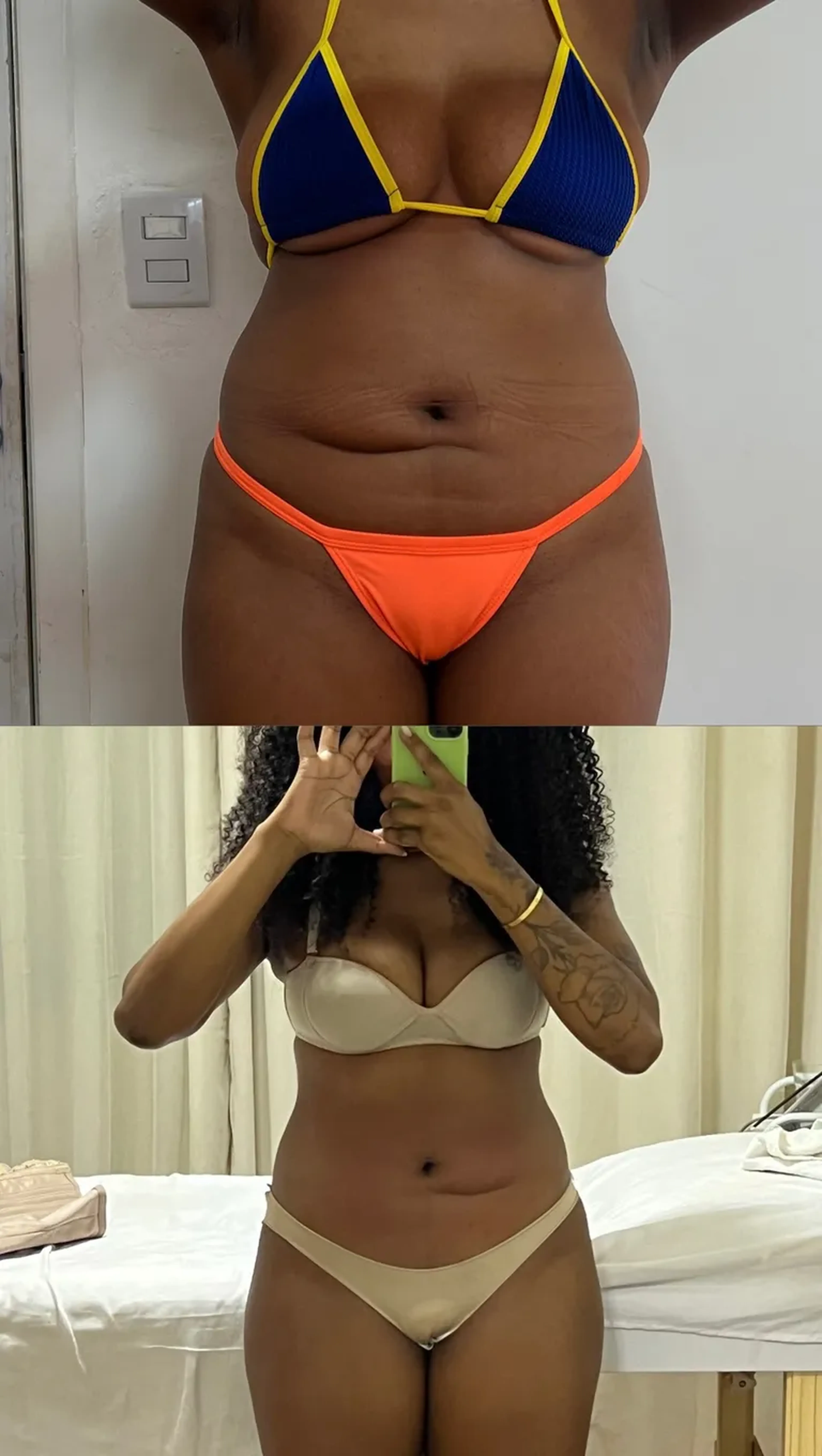 Sessão Enzimas Lipoturbinada + Modeladora Local imagem