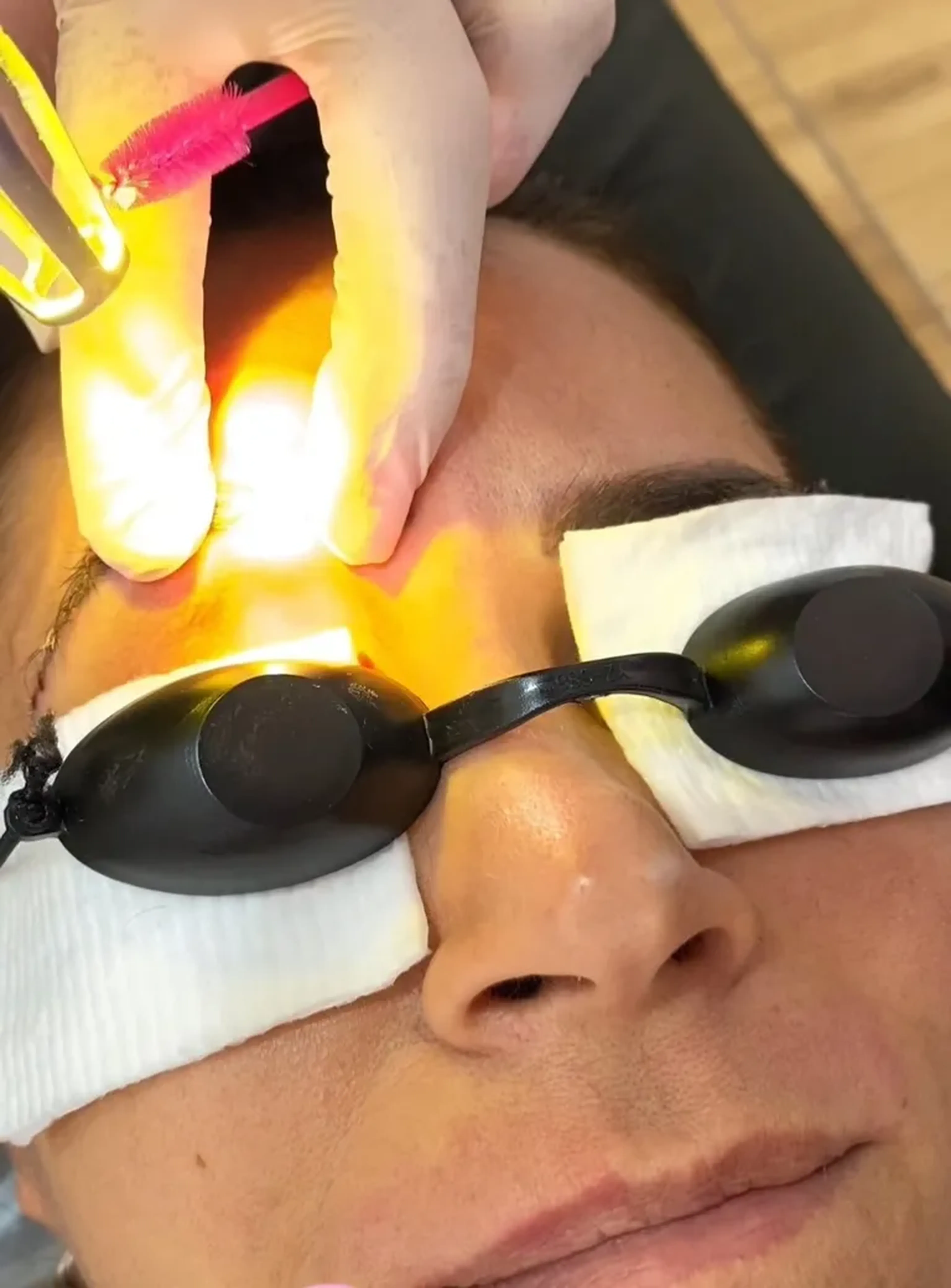 Despigmentação de sobrancelhas imagem