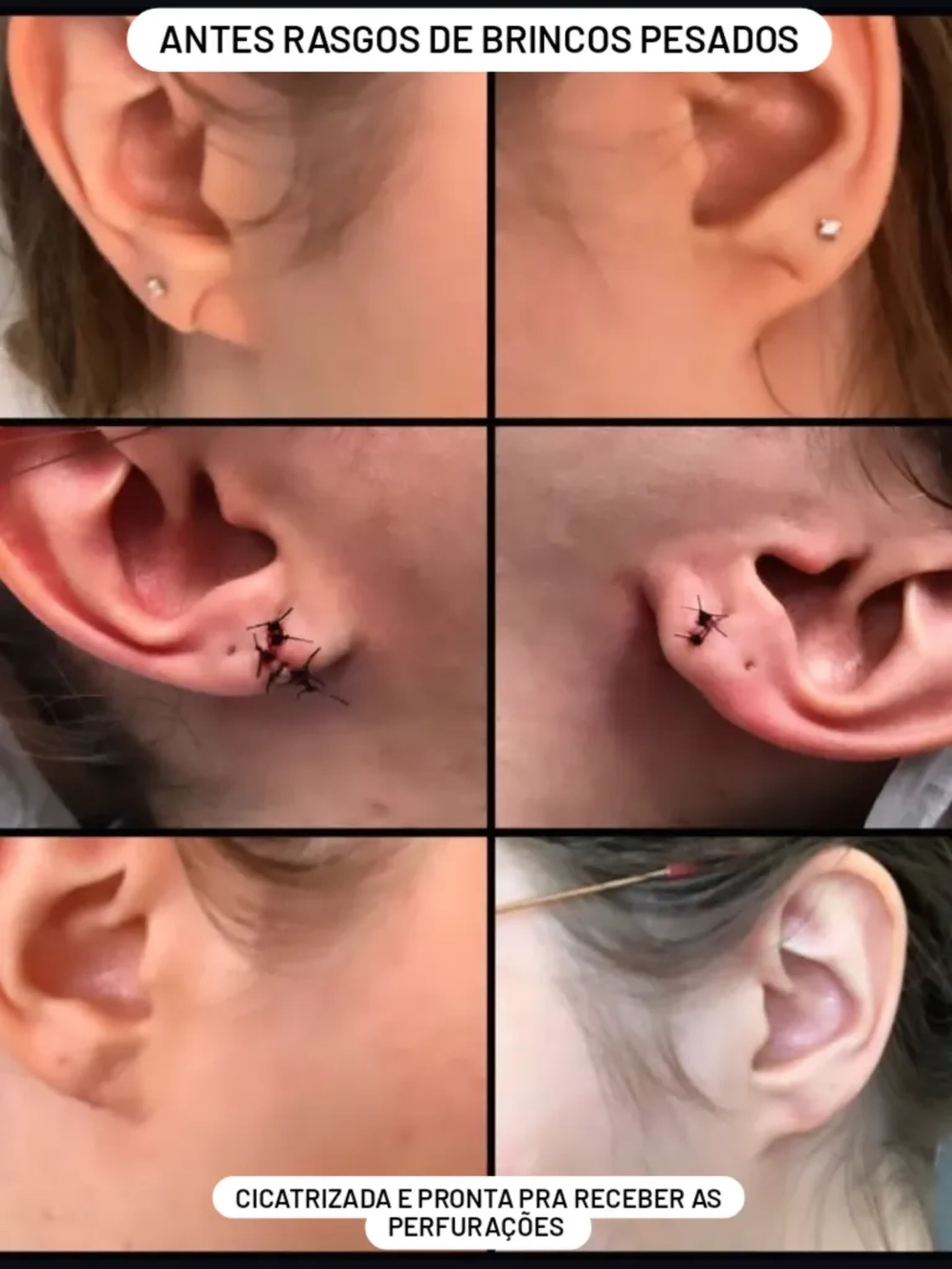 Lobuloplastia (rasgo de brinco) cada lado imagem