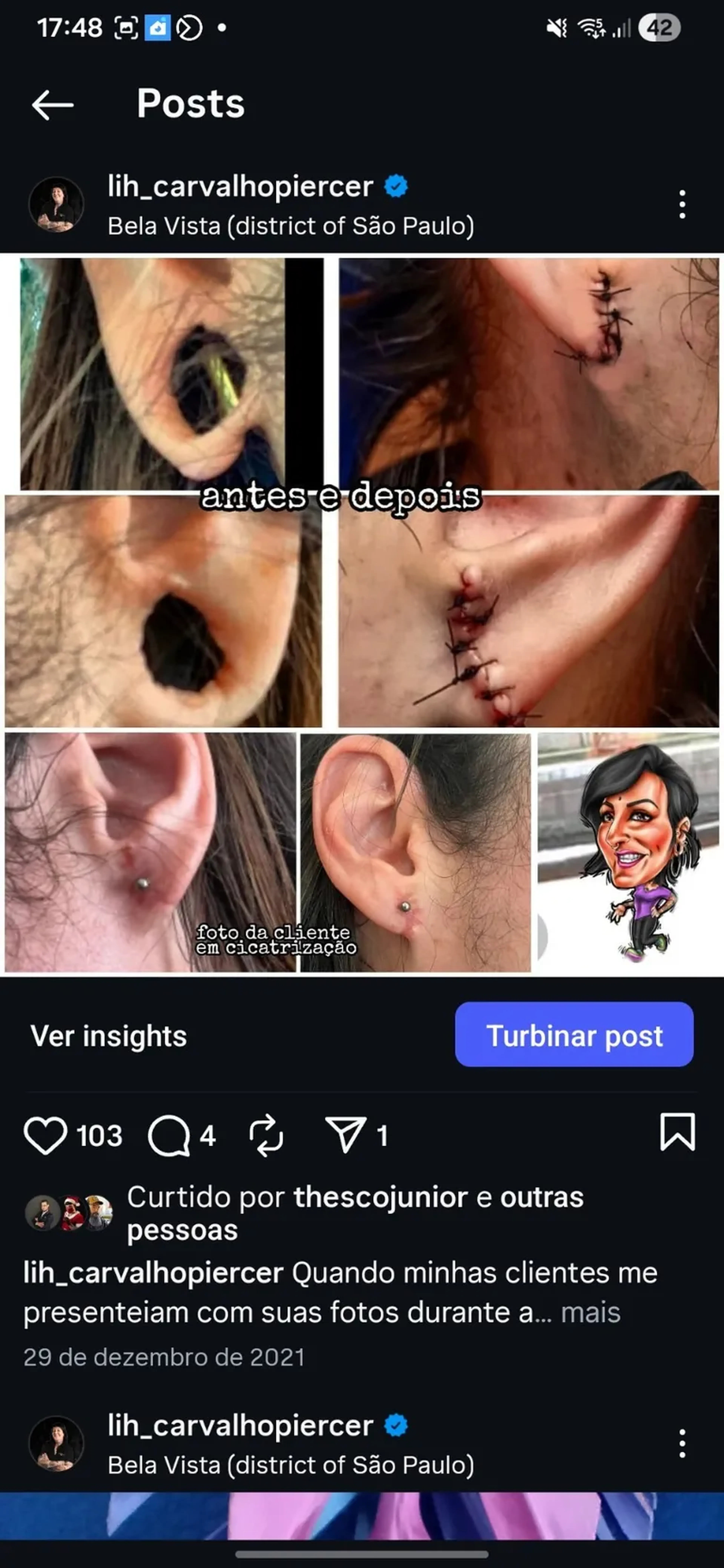 Reconstrução de lóbulos (dilatação) 1 lado imagem