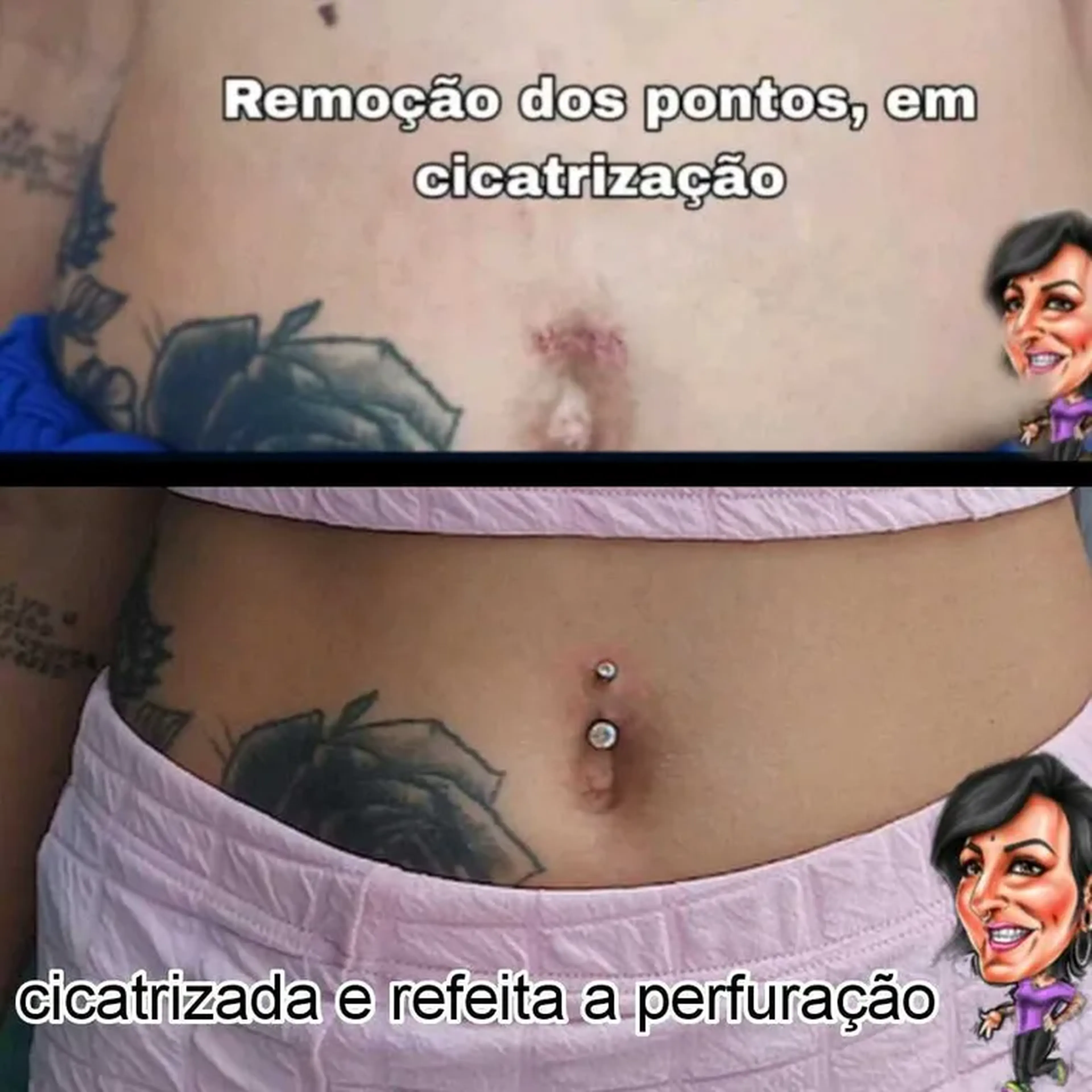 Reconstrução umbigo imagem