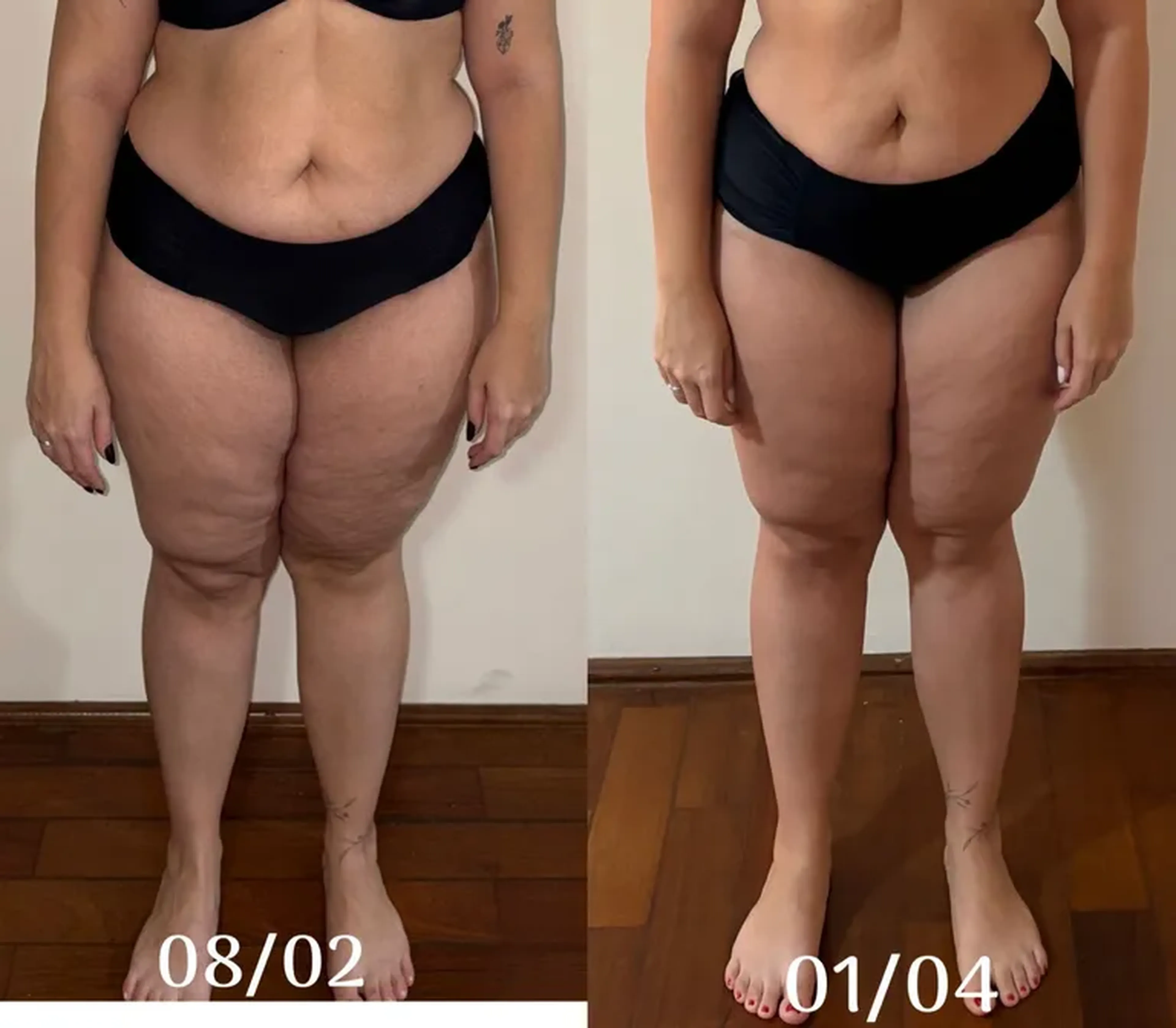 Sessão Drenagem long Lash Lipoedema imagem